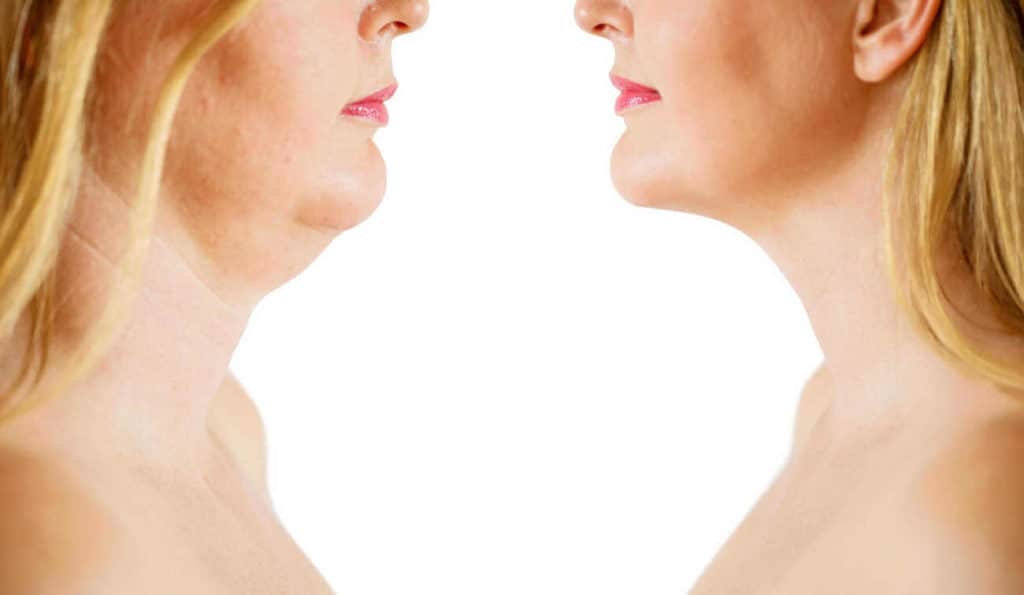 Double Chin treatment Sudbury before and after results