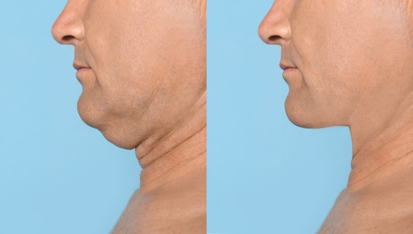 Which Non-Surgical Treatments Work Best for Jowls and Loose Skin Sudbury?