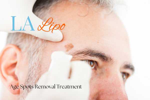 What Are the Most Effective Treatments for Age Spots Sudbury?