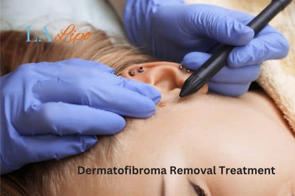 Dermatofibroma Removal Treatment Sudbury