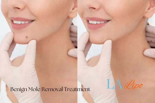 woman's before and after mole removal Sudbury results