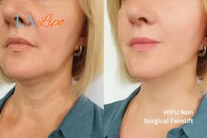 hi-fu for wrinkles Sudbury before and after results
