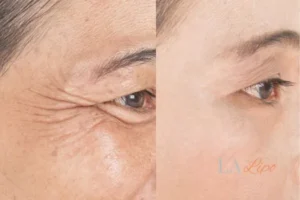 Before and after results of woman - HI-fu wrinkles reduction treatment Sudbury
