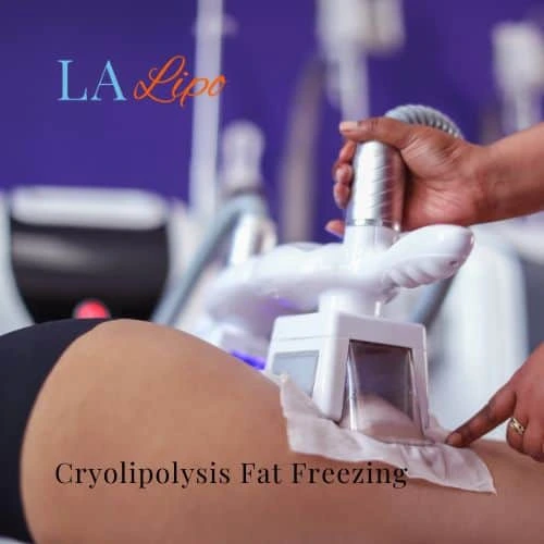 fat freezing - Cryolipolysis Sudbury