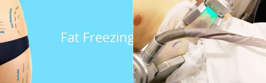 Fat freezing Sudbury on multiple areas of the body