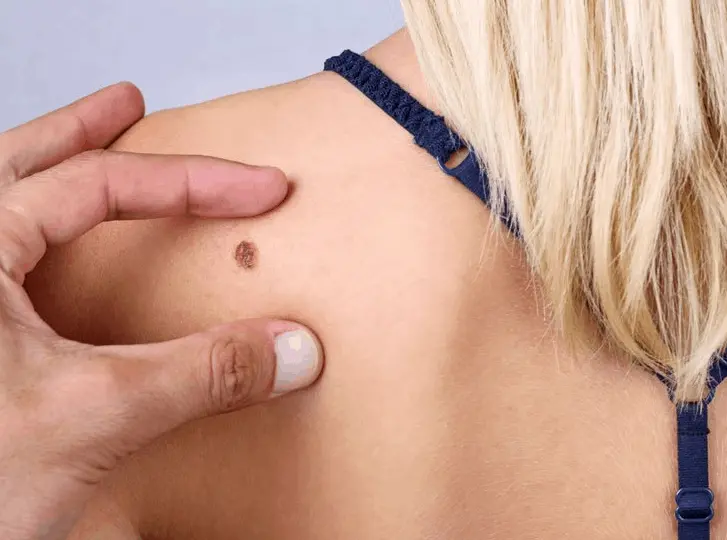 woman having mole removal Sudbury consultation before treatment.
