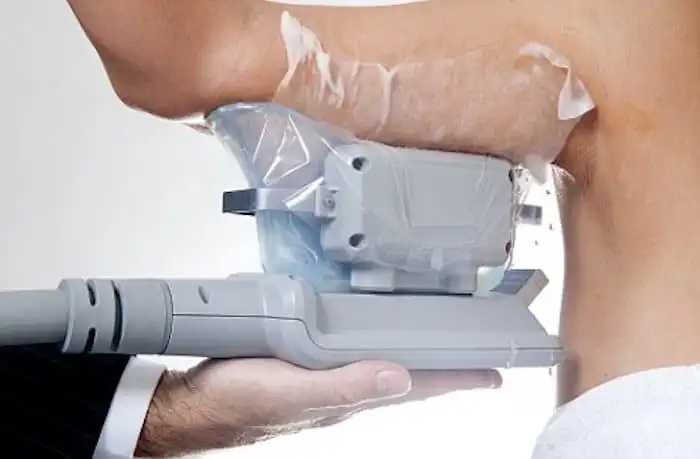 Picture of fat freezing Sudbury on the upper arms.