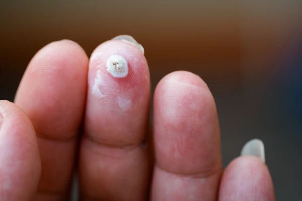 wart on person finger - cryotherapy to treat from LA LIPO Sudbury