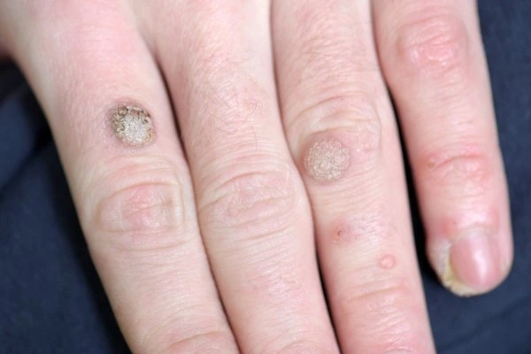 photo of warts on person hand - see wart removal Sudbury from LA LIPO