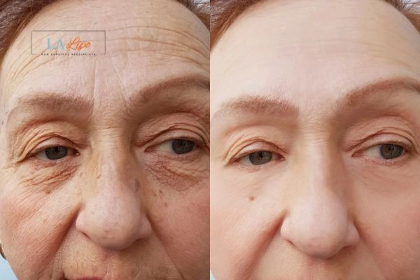 The powerful benefits of Morpheus8 Treatment Sudbury - Call Our team today!