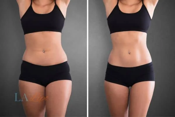 before and after results of non-surgical treatment to help a woman's body image and mental health Sudbury