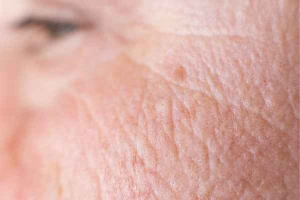 close up picture of a woman's face showing an age spot Sudbury