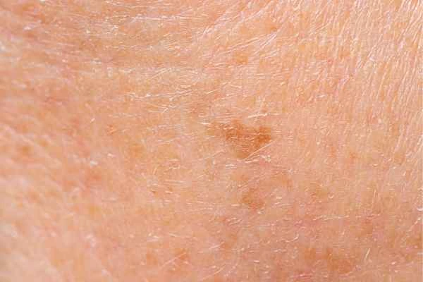 close up picture of age spots Sudbury