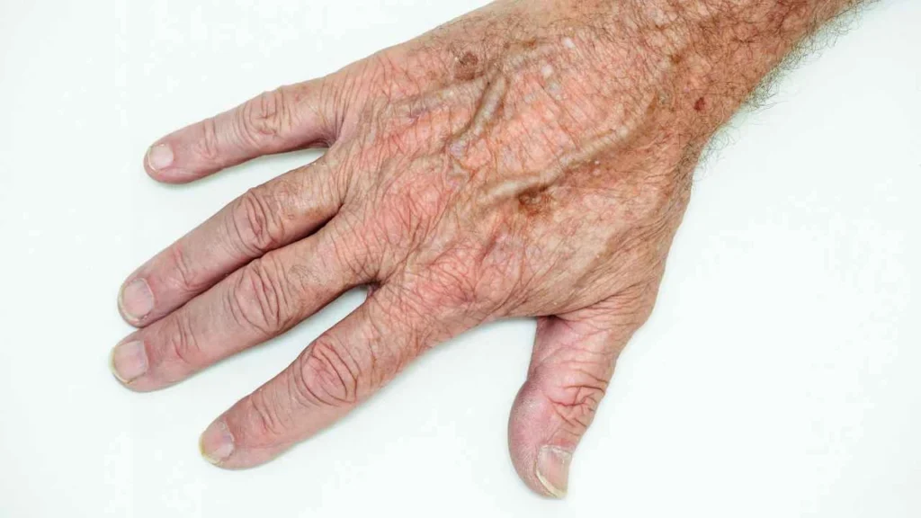 Male hand showing age spot Sudbury