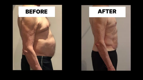 What Symptoms Can Diastasis Recti Cause in Men? Weak Core, Back Pain and Poor Posture Sudbury